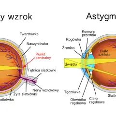 Skąd się bierze astygmatyzm? Poznaj przyczyny i objawy tej wady wzroku