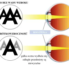 Jaka soczewka na krótkowzroczność? Wybierz najlepszą dla siebie!