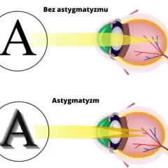 Astygmatyzm jak widzi światła – zrozum, co widzisz i jak to leczyć