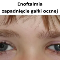 Enoftalmia, czyli zapadnięcie gałki ocznej. Czy oko może wypaść? Nie, ale wygląda na cofnięte.