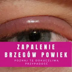 Oko z zaczerwienionym, opuchniętym brzegiem powieki, wskazujące na łojotokowe zapalenie powiek.