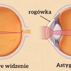 Czy astygmatyzm może się zmniejszyć? Poznaj prawdę o leczeniu i wieku