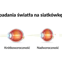 Jakie soczewki na astygmatyzm wybrać - kompletny poradnik dla pacjentów