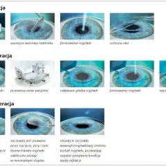 Ilustracje pokazują etapy korekcji wady wzroku metodami PRK, LASIK i SMILE.