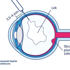 Ilustracja przedstawia iniekcje doszklistkowe, podanie leku do oka w celu leczenia obrzęku plamki żółtej.