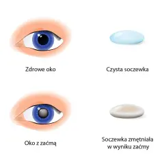 Ile się czeka na operację zaćmy? Poznaj zaskakujące fakty i terminy