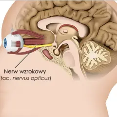 Schematyczny przekrój głowy ukazujący oko i mózg. Strzałka wskazuje nerw wzrokowy, którego uszkodzenie może prowadzić do utraty wzroku.