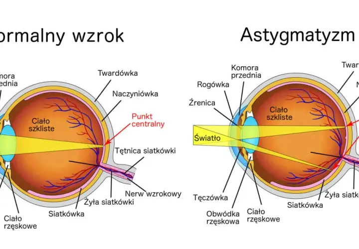 Skąd się bierze astygmatyzm? Poznaj przyczyny i objawy tej wady wzroku