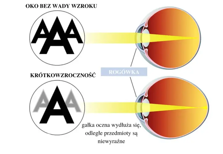 Jaka soczewka na krótkowzroczność? Wybierz najlepszą dla siebie!