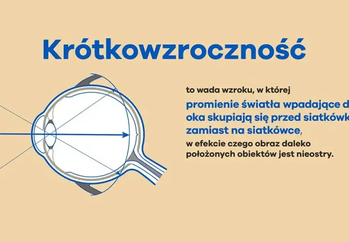 Krótkowzroczność: przyczyny i objawy, które mogą cię zaskoczyć