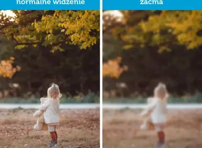 Czy przy zaćmie boli oko? Odkryj prawdę o bólu oczu