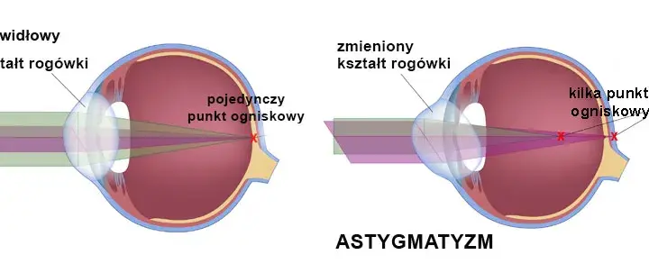 Największa wada wzroku: jakie powikłania grożą Twoim oczom?