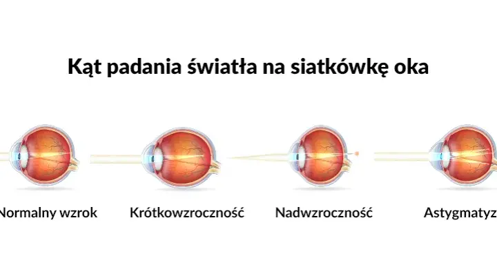Jakie soczewki na astygmatyzm wybrać - kompletny poradnik dla pacjentów