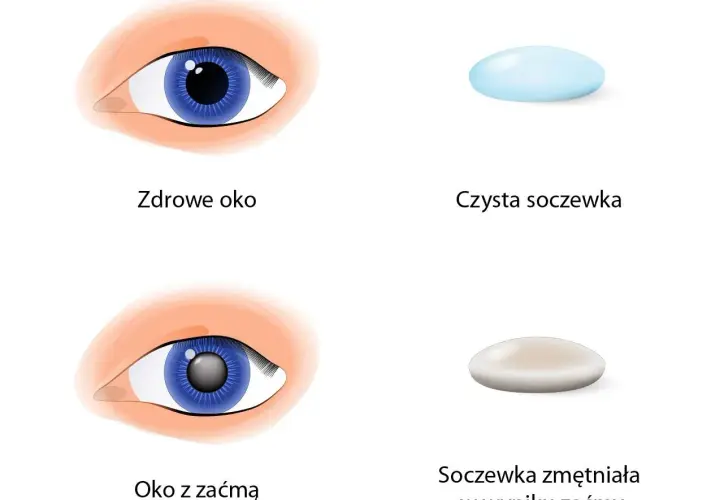 Ile się czeka na operację zaćmy? Poznaj zaskakujące fakty i terminy