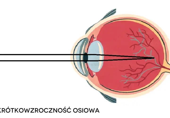Czy wada wzroku minus może się cofnąć: Prawda o leczeniu krótkowzroczności
