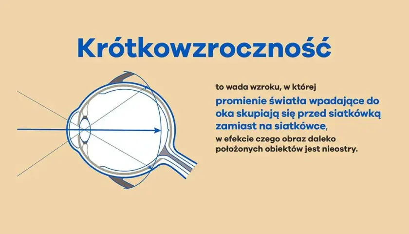 Krótkowzroczność: przyczyny i objawy, które mogą cię zaskoczyć