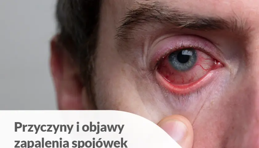 Silnie zaczerwienione oko z widocznymi naczynkami, objaw ropnego zapalenia spojówek.
