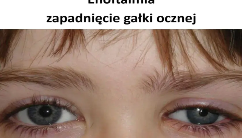Enoftalmia, czyli zapadnięcie gałki ocznej. Czy oko może wypaść? Nie, ale wygląda na cofnięte.