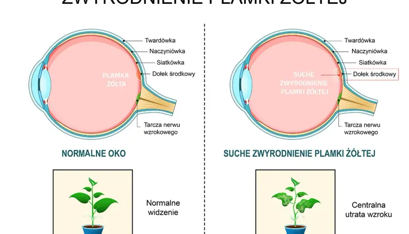 Porównanie budowy oka zdrowego i z suchym zwyrodnieniem plamki żółtej. Obraz pokazuje, jak szybko powiększa się otwór plamki żółtej, prowadząc do utraty wzroku.