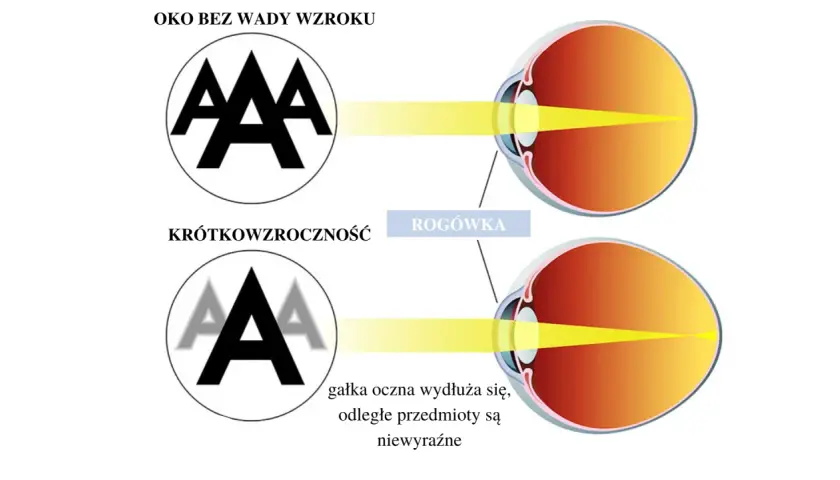 Poznaj wszystkie wady wzroku i ich wpływ na codzienne funkcjonowanie