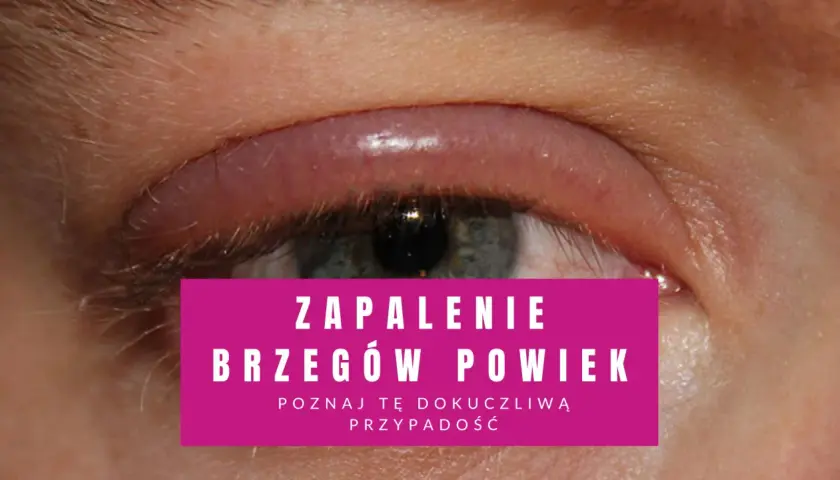 Oko z zaczerwienionym, opuchniętym brzegiem powieki, wskazujące na łojotokowe zapalenie powiek.