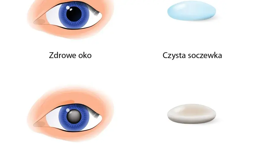 Ile się czeka na operację zaćmy? Poznaj zaskakujące fakty i terminy