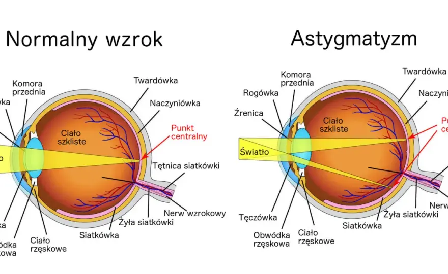 Skąd się bierze astygmatyzm? Poznaj przyczyny i objawy tej wady wzroku