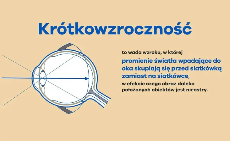 Krótkowzroczność: przyczyny i objawy, które mogą cię zaskoczyć