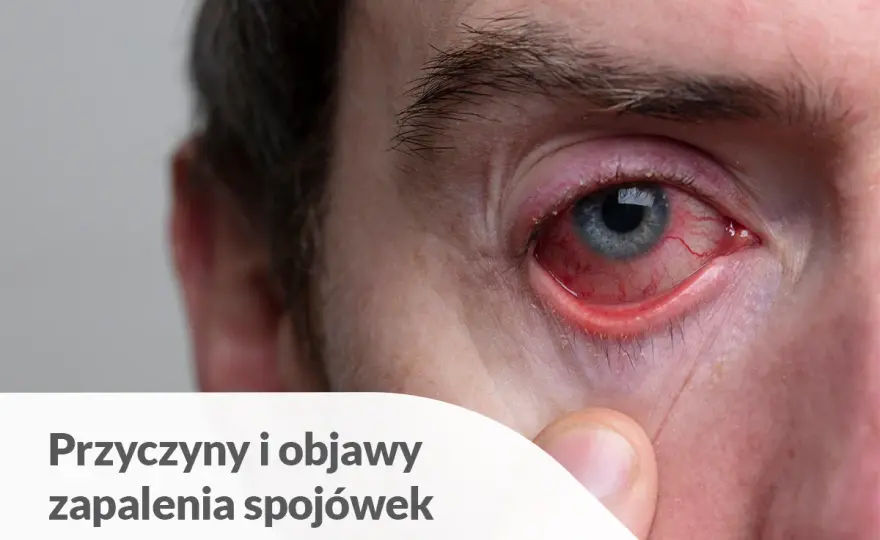 Ropne zapalenie spojówek - jak leczyć i kiedy do lekarza?