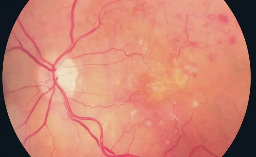 Retinopatia cukrzycowa - leczenie, objawy i ochrona wzroku