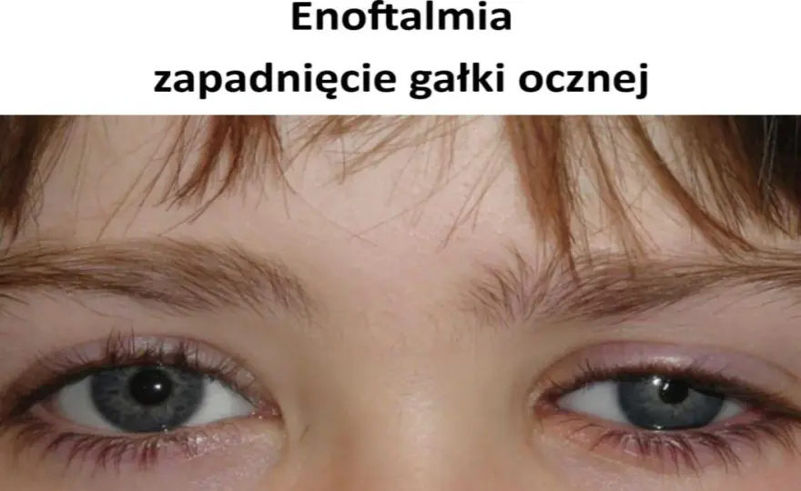Wysunięcie gałki ocznej - Kiedy oko wypada i co robić?