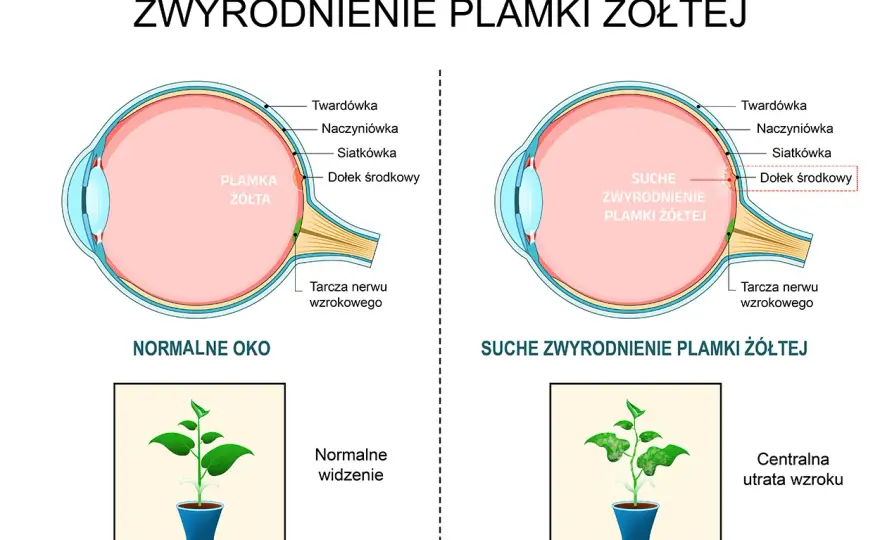 Otwór plamki żółtej - Jak szybko rośnie i co to oznacza?
