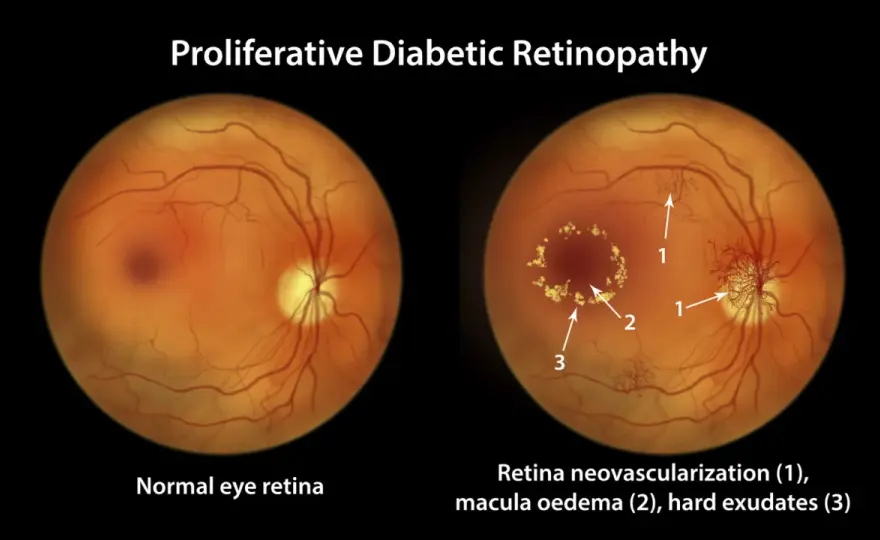 Retinopatia - objawy, leczenie i kiedy pilnie do lekarza?