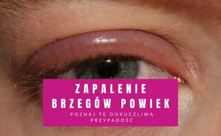 Zapalenie brzegów powiek - objawy i skuteczne leczenie