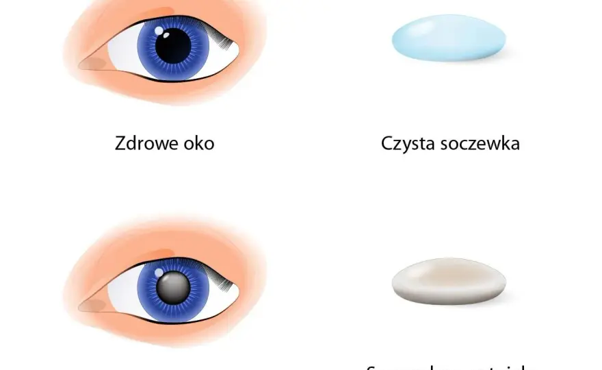 Ile się czeka na operację zaćmy? Poznaj zaskakujące fakty i terminy