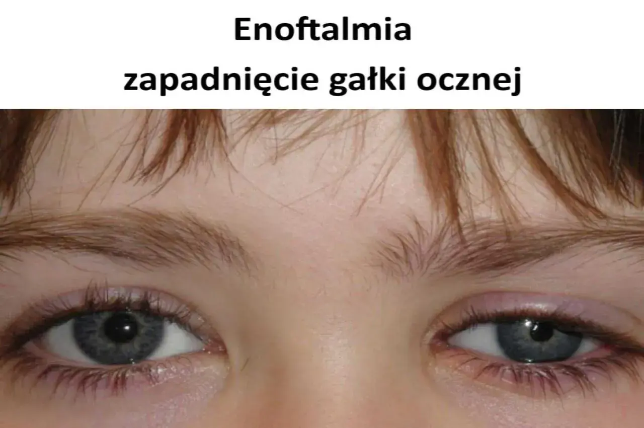 Enoftalmia, czyli zapadnięcie gałki ocznej. Czy oko może wypaść? Nie, ale wygląda na cofnięte.