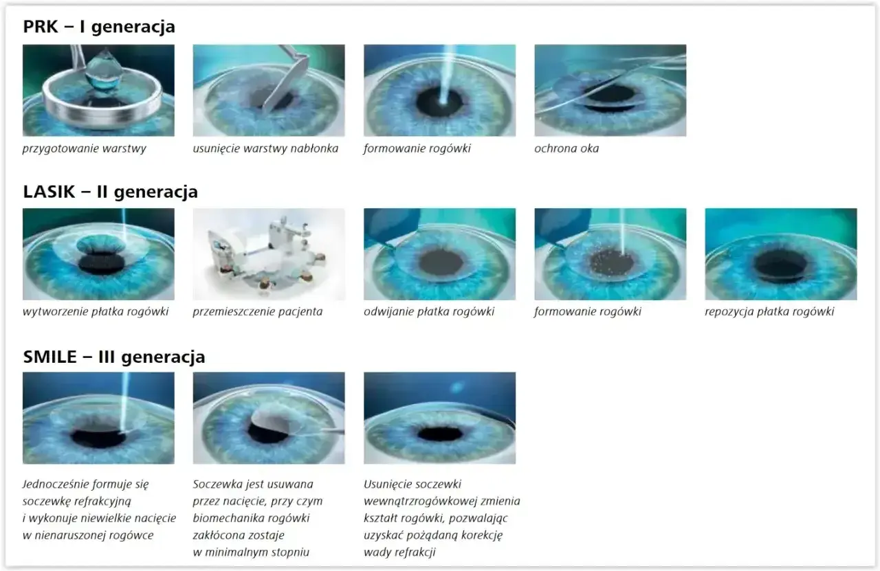 Ilustracje pokazują etapy korekcji wady wzroku metodami PRK, LASIK i SMILE.