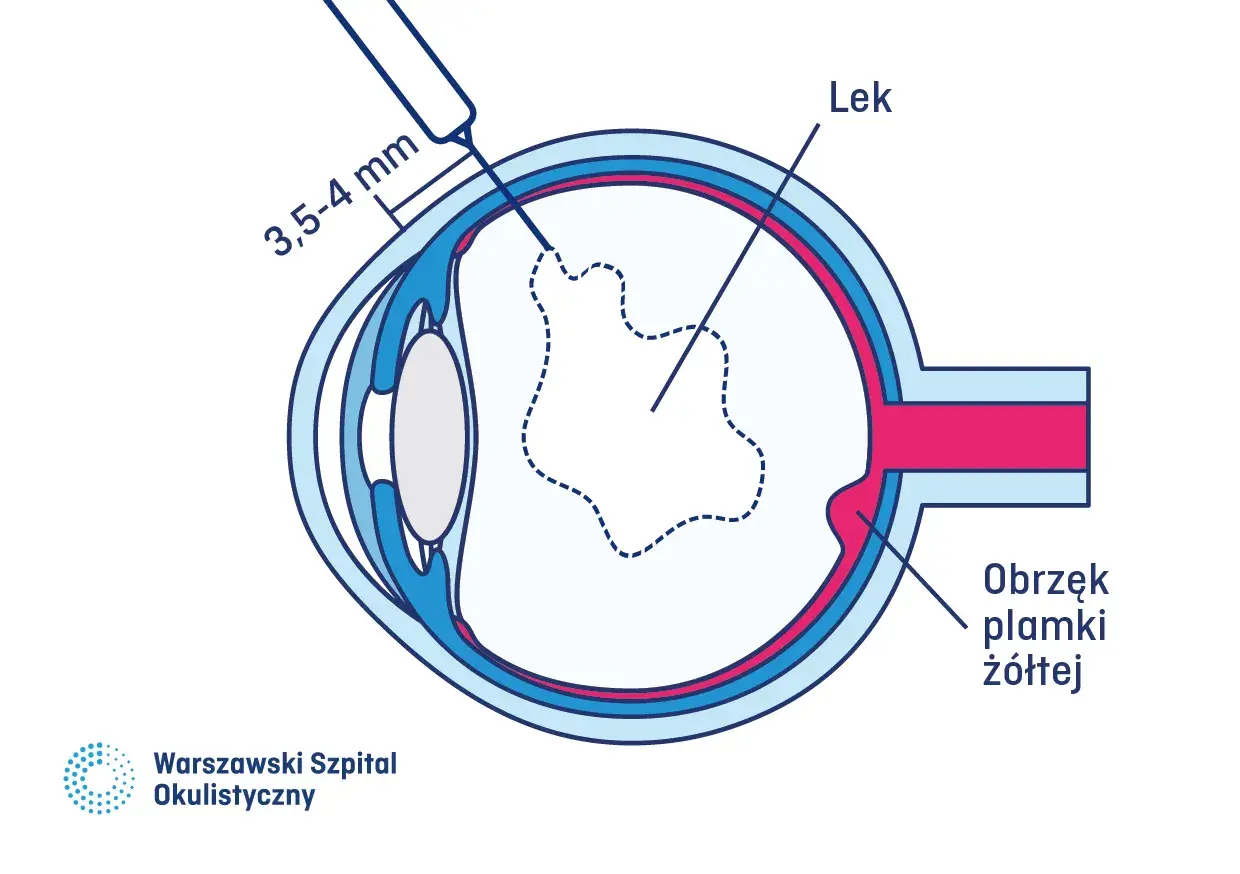 Ilustracja przedstawia iniekcje doszklistkowe, podanie leku do oka w celu leczenia obrzęku plamki żółtej.