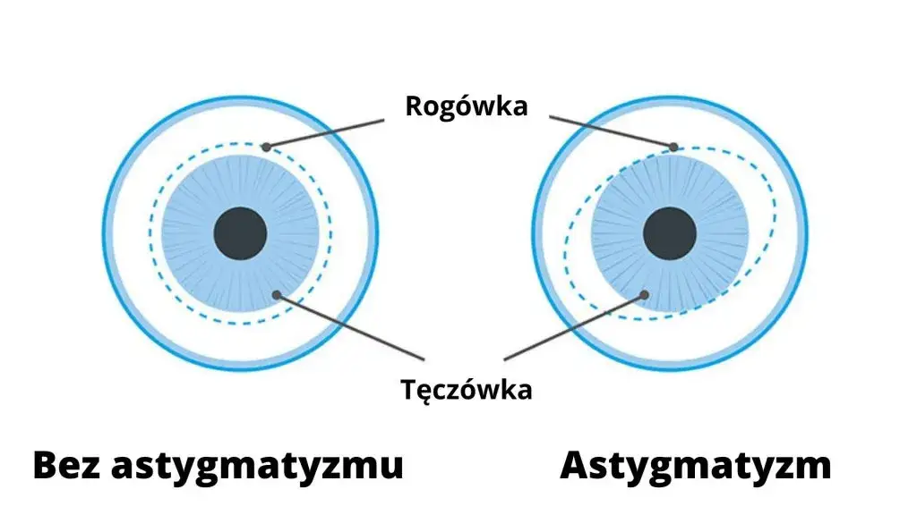 Zdjęcie Czy astygmatyzm może się zmniejszyć? Poznaj prawdę o leczeniu i wieku