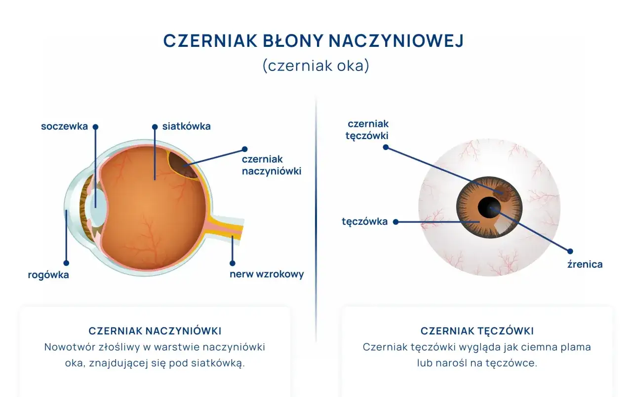 Ilustracja przedstawia budowę oka z zaznaczonym czerniakiem naczyniówki i czerniakiem tęczówki.