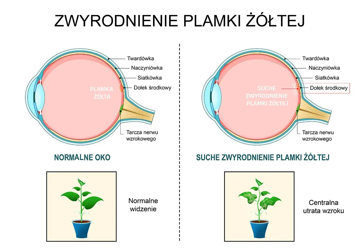 Porównanie normalnego oka z suchym zwyrodnieniem plamki żółtej. Widzenie na żółto może być objawem.